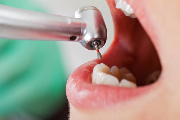Best Emergency Broken Tooth Repair in Baird, TX